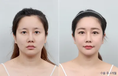 Before & After