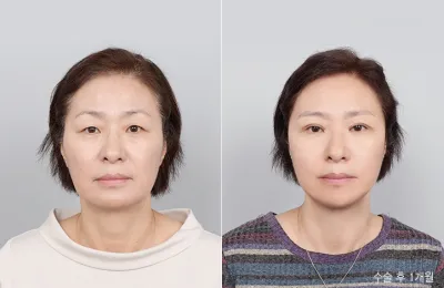 Before & After