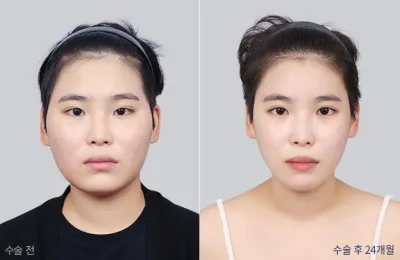 Before & After