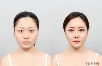 Before & After