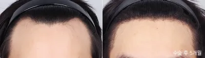 Before & After