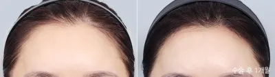 Before & After