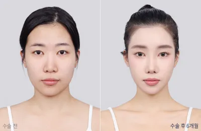 Before & After