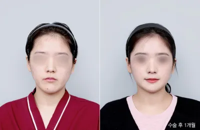 Before & After