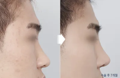 Before & After