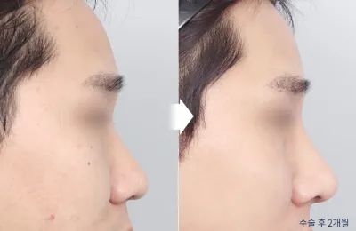 Before & After