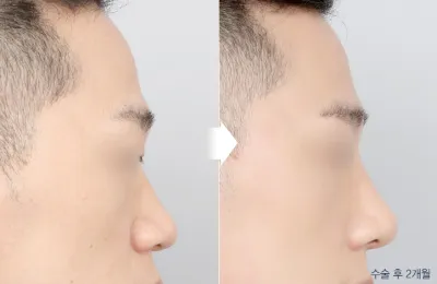 Before & After