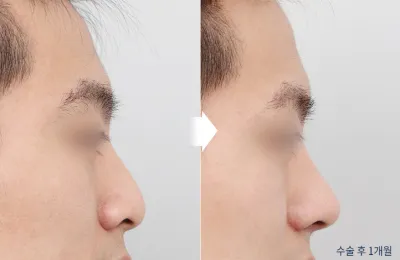 Before & After