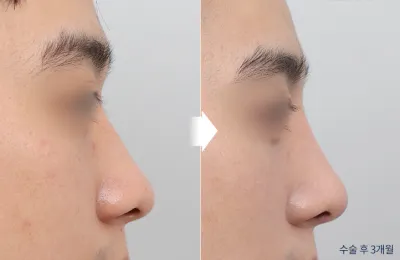 Before & After