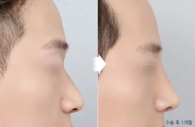 Before & After