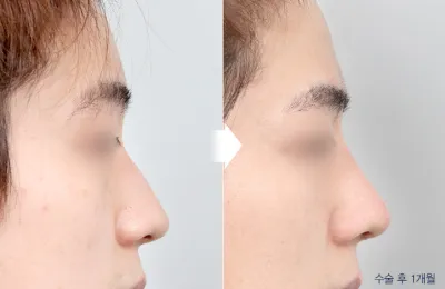 Before & After