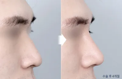 Before & After