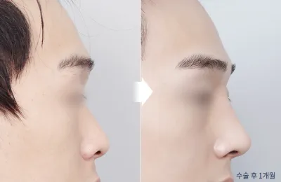Before & After