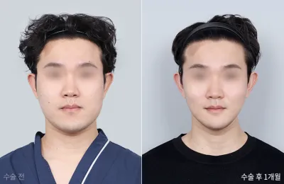 Before & After