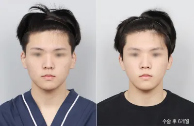 Before & After