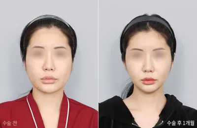 Before & After