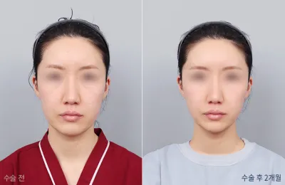 Before & After
