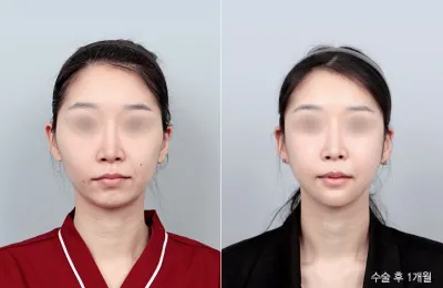 Before & After