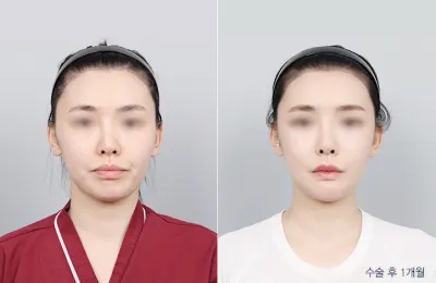 Before & After
