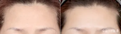 Before & After