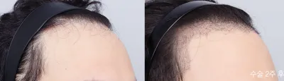 Before & After