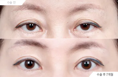 Before & After