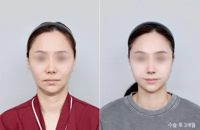Before & After