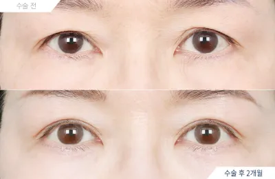 Before & After