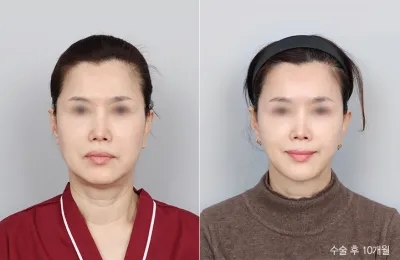 Before & After