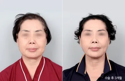 Before & After