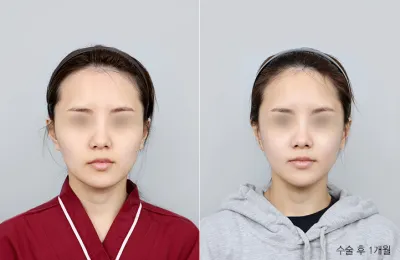 Before & After