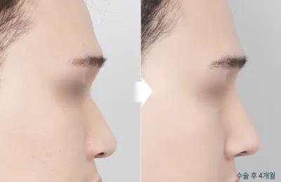 Before & After