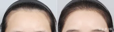 Before & After