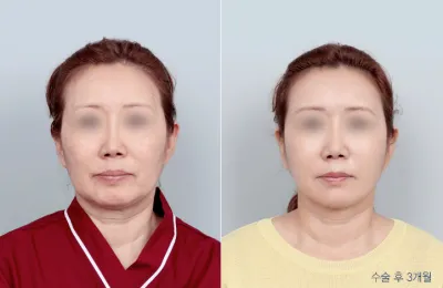 Before & After