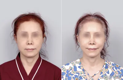 Before & After