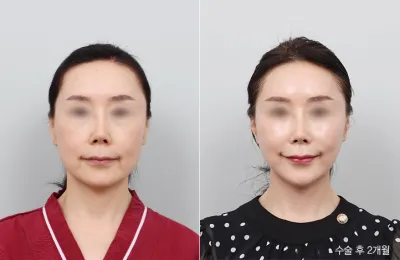 Before & After
