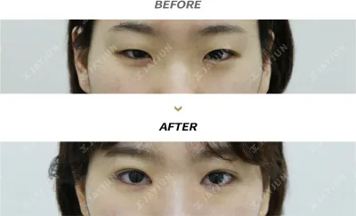 Before & After
