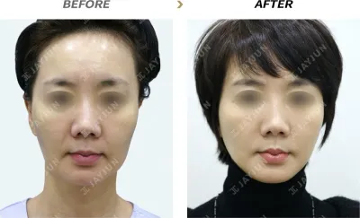 Before & After