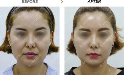 Before & After