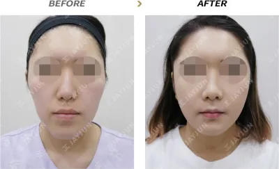 Before & After