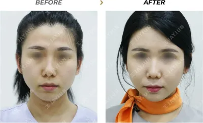Before & After