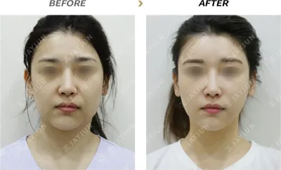 Before & After