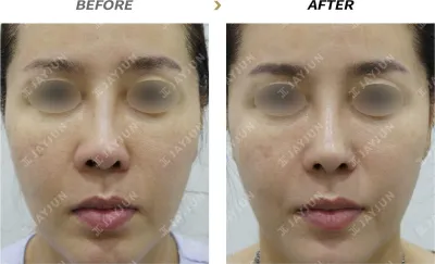 Before & After