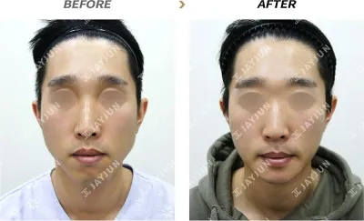 Before & After