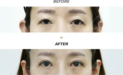Before & After