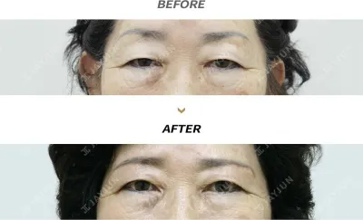 Before & After