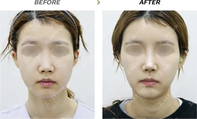 Before & After