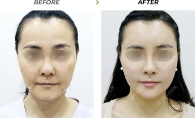 Before & After