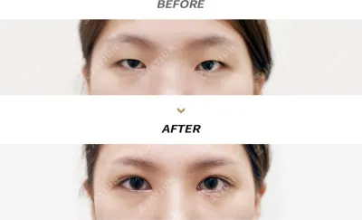 Before & After
