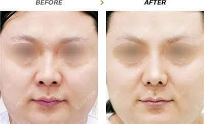 Before & After